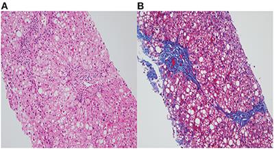 Case Report: The Association of Wilson Disease in a Patient With Ataxia and GLUT-1 Deficiency